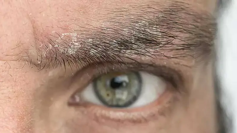 Simple Home Remedies To Tackle Eyebrow Dandruff Naturally
