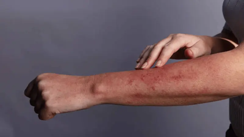 Heat Rash: ചൂടുകുരു മാറ്റാം, ചെയ്യേണ്ടത് ഈ നിസ്സാരകാര്യങ്ങള്‍