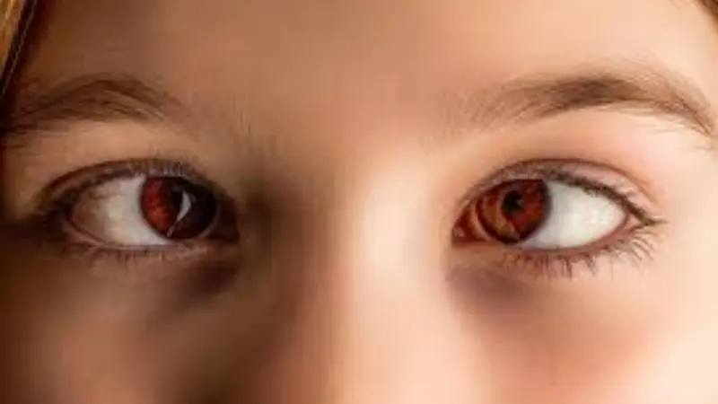 मोफत तिरळेपणा शस्त्रक्रिया शिबिरास प्रचंड प्रतिसाद