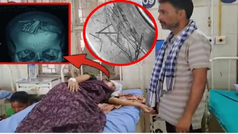 77 Needles Removed From Woman's Head After Surgery