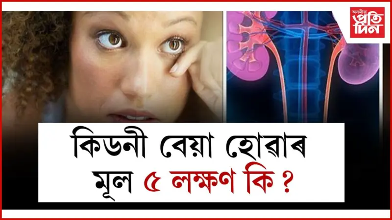 চকুৱে দিয়ে কিডনী বেয়া হোৱাৰ খবৰ