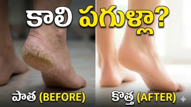 కాలి పగుళ్లతో నరకం చూస్తున్నారా? ఇంట్లోని ఈ 3 వస్తువులతో శాశ్వతంగా చెక్ పెట్టండి..