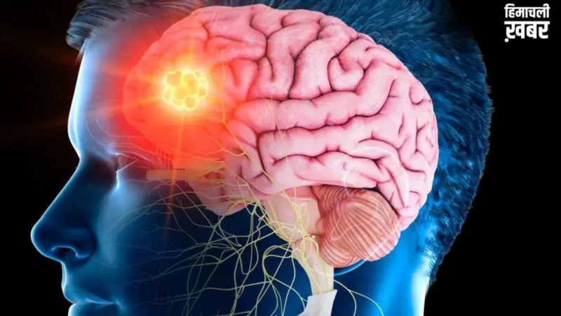 Brain stroke recovery : ब्रेन स्ट्रोक के बाद रिकवरी भी है जरूरी, डॉक्टर से जानें टिप्स