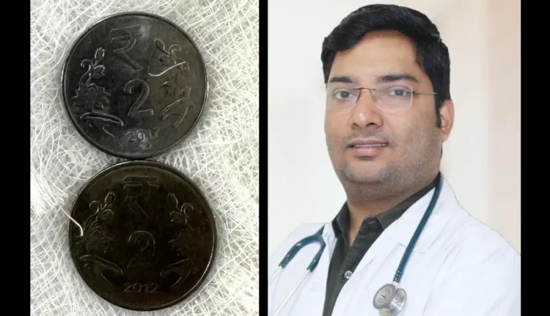 चिमुकल्याने गिळलेली दोन नाणी बाहेर काढण्यात डॉक्टरांना यश!
