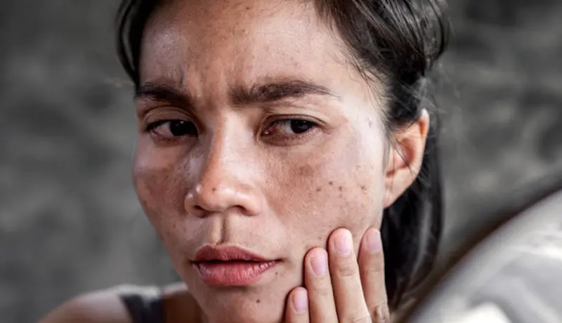 7 Effective Home Remedies To Treat Sun Burn Patches On Skin