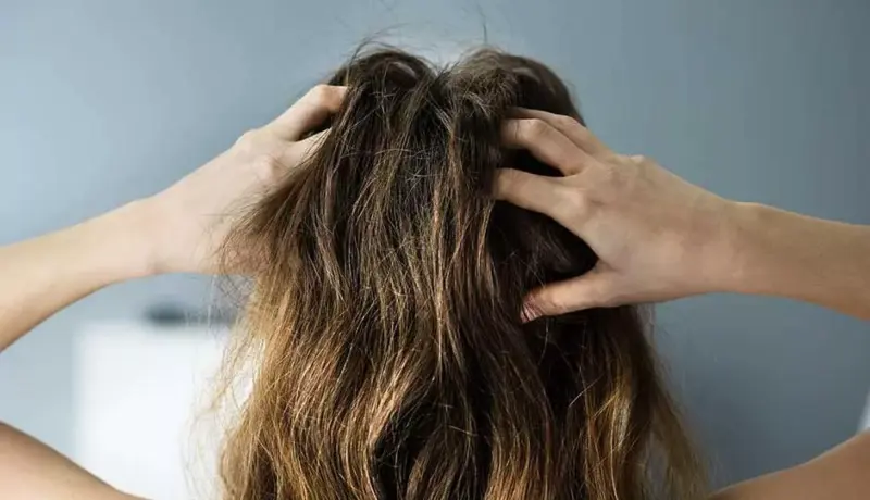 8 Home Remedies To Treat Itchy Scalp In Summers