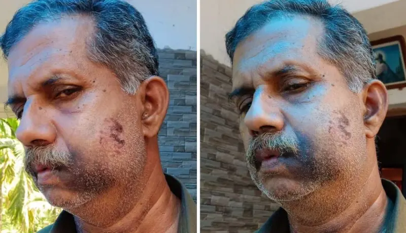 चौथीच्या वर्गात झालेल्या भांडणाचा ५० वर्षांनी घेतला बदला; दातच तोडले.