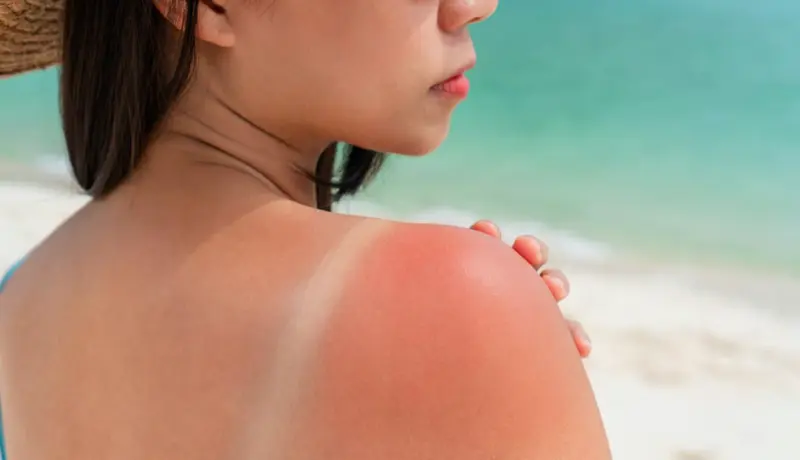 9 Effective Home Remedies To Treat Sun Burn