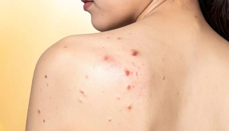 8 Home Remedies To Treat Back Acne