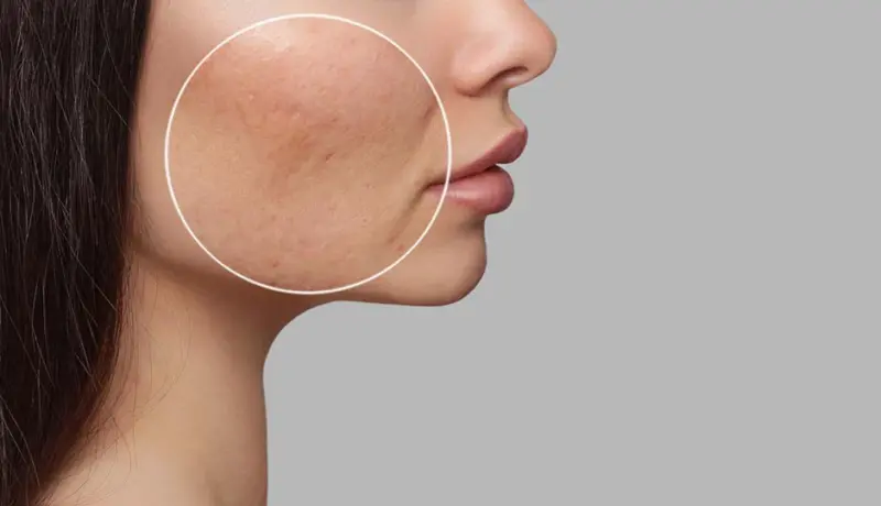 8 Home Remedies To Reduce Scars On Skin