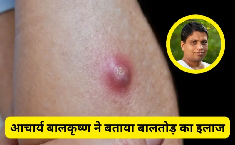 बालतोड़ का इलाज जल्दी कैसे करें?ˈ Acharya Balkrishna ने बताया कैसे ठीक होंगे ये फोड़ेˌ!