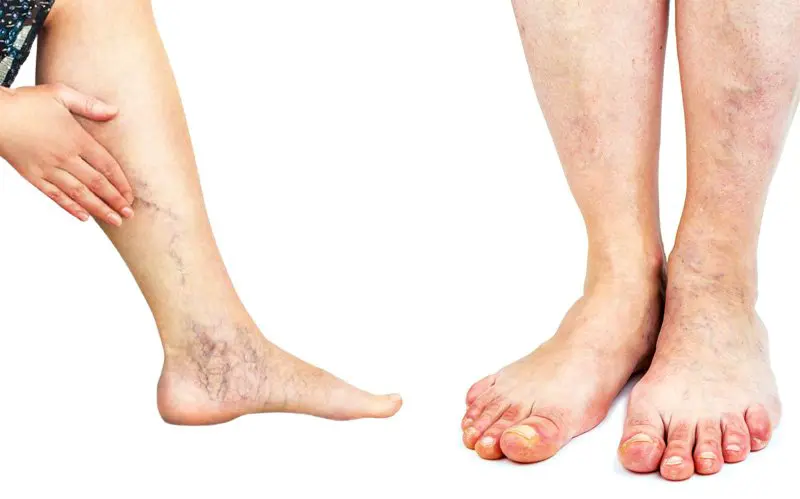 पैरˈ की नस चढ़ने से हैं परेशान? अपनाएं ये 6 उपाय तुरंत ठीक हो जाएगा नसों का दर्द व खिंचाव