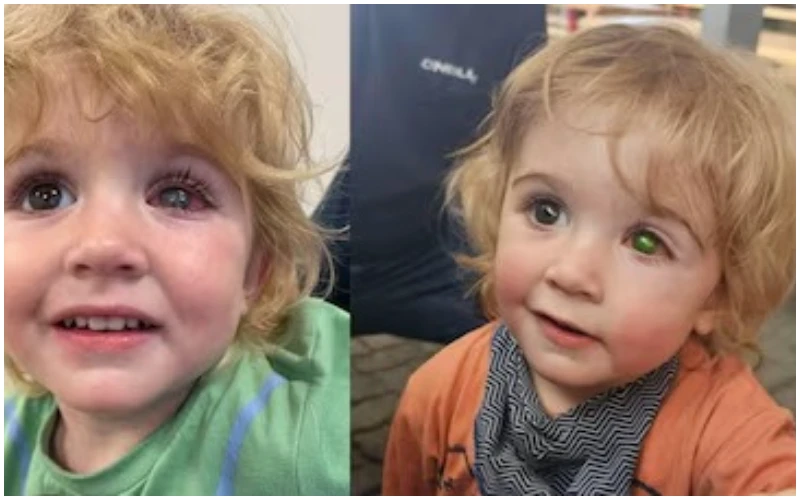 চুম্বনে কোল্ড সোর ভাইরাস সংক্রমণ: নামিবিয়ায় এক শিশুর দৃষ্টিশক্তি হারানোর সতর্কবার্তা