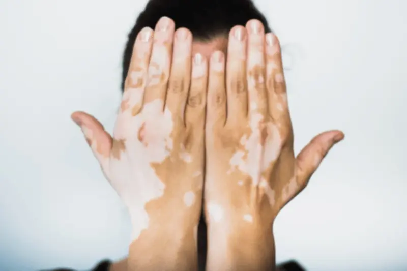 White Patches on Skin: Discover Causes, Preventive Measures, and Natural Healing Options