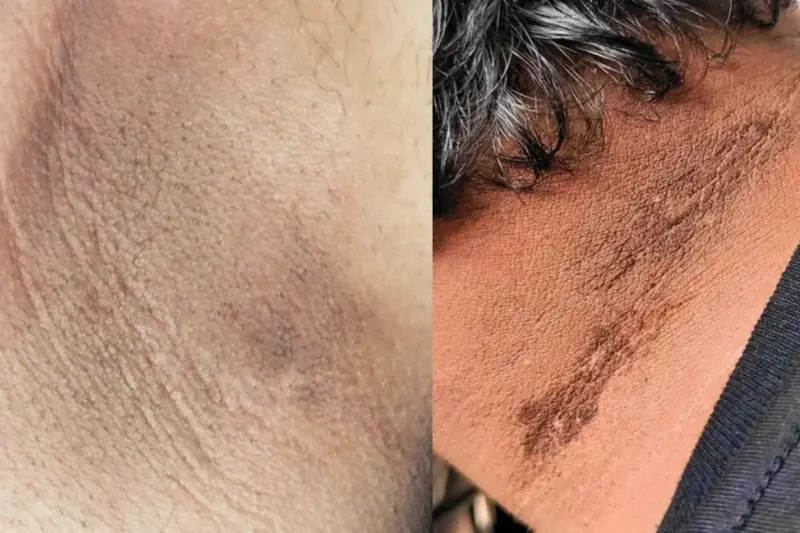 Diabetes: Black Patches On Your Neck Or Underarms? Could Be Pre-Diabetes Knocking, Gut Health Coach Weighs In