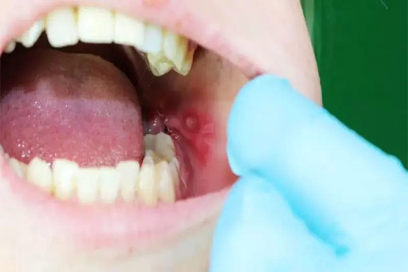 Tongue Ulcers: जीभ पर छाले क्यों होते हैं? इसका इलाज कैसे करें?