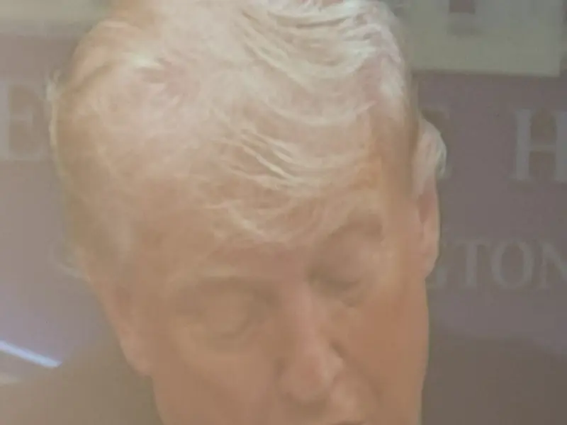 Is Trump Turning Bald? Viral Pictures Of US President Trigger Hair Debate Online After Walter Reed Visit Rumors