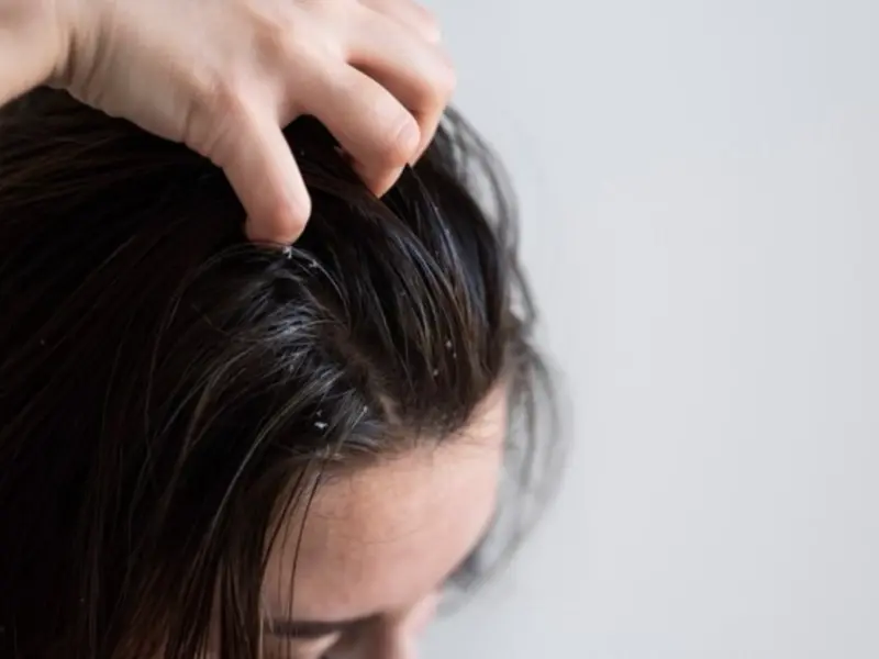 Summer Scalp Care: Expert Shares How To Keep Dandruff In Check When Temperatures Rise