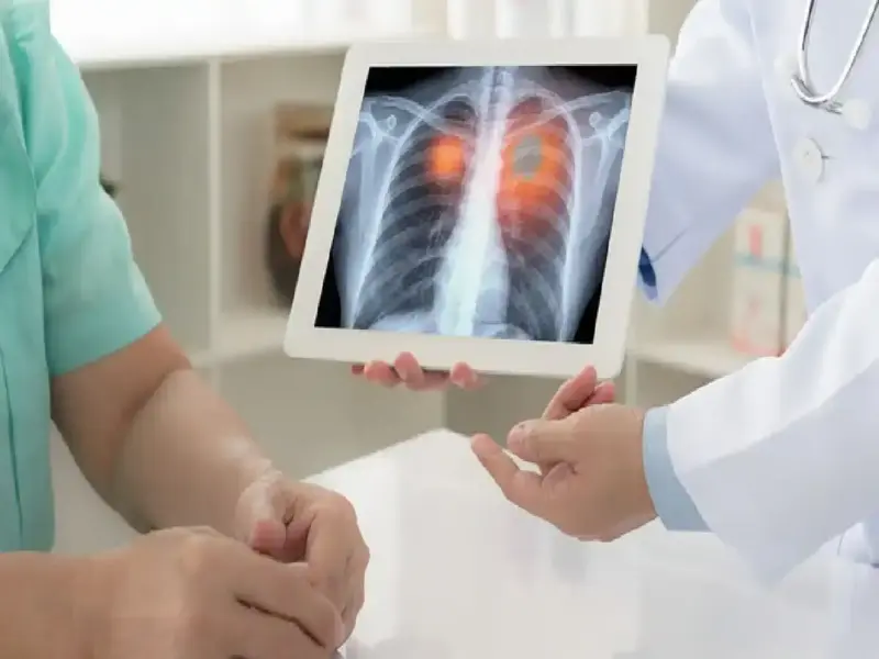 Lung cancer: If you notice these changes in your nails, it could be lung cancer; read about its symptoms
