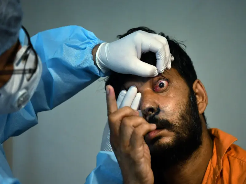 Study finds high drug resistance in bacteria causing eye infections in India