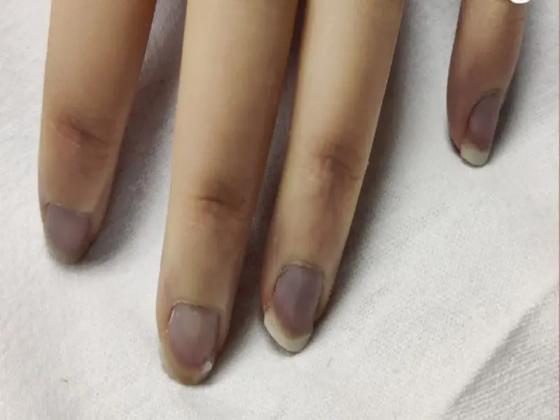 Nail color change: If your nails are turning blue, it could be a sign of these diseases; see a doctor as soon as symptoms appear