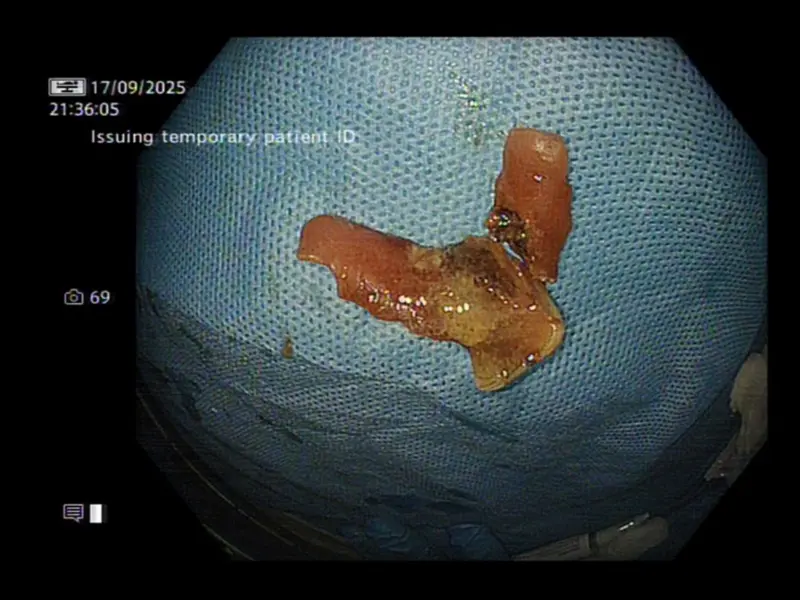 Delhi doctors remove stuck denture using laser, avoiding major surgery