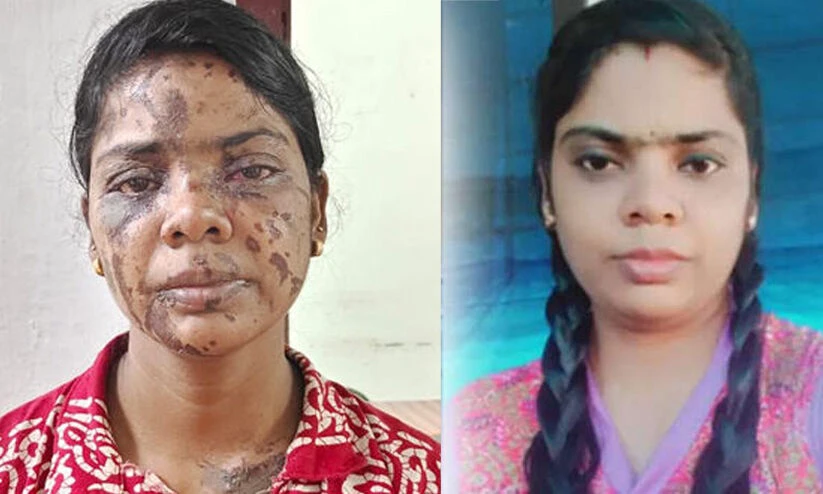 ഭര്‍ത്താവിനോട് പറഞ്ഞത് തിളച്ച കഞ്ഞിവെള്ളം വീണ് പൊള്ളിയതെന്ന്; ഷീബ പിടിയിലാകുന്നത് ആസിഡ് ആക്രമണത്തിന്‍റെ അഞ്ചാംനാള്‍