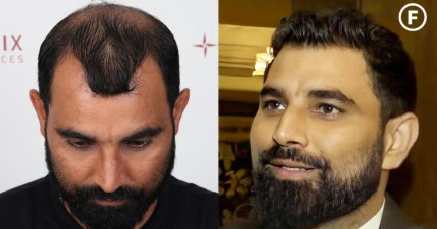 Mohammed Shami ने ऐसा क्या किया जो गंजे सिर पर आ गए घने बाल, सामने आई ये सच्चाई….